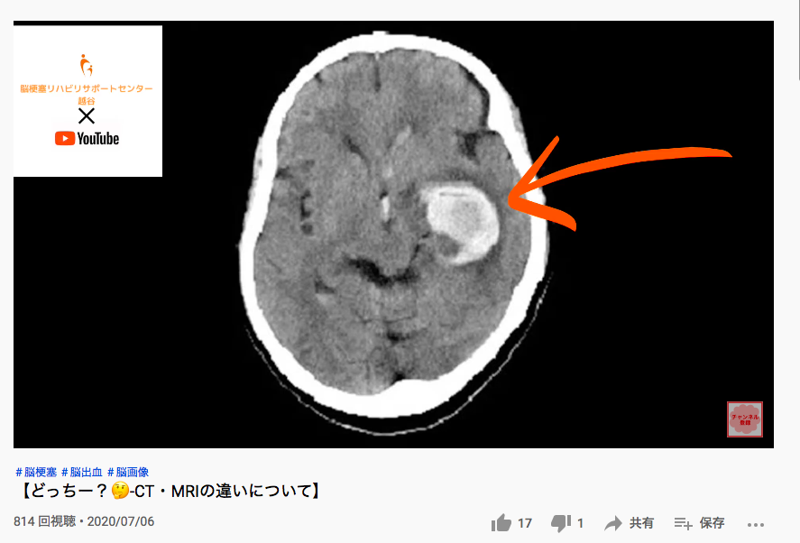 脳梗塞リハビリサポートセンター越谷　YouTube！